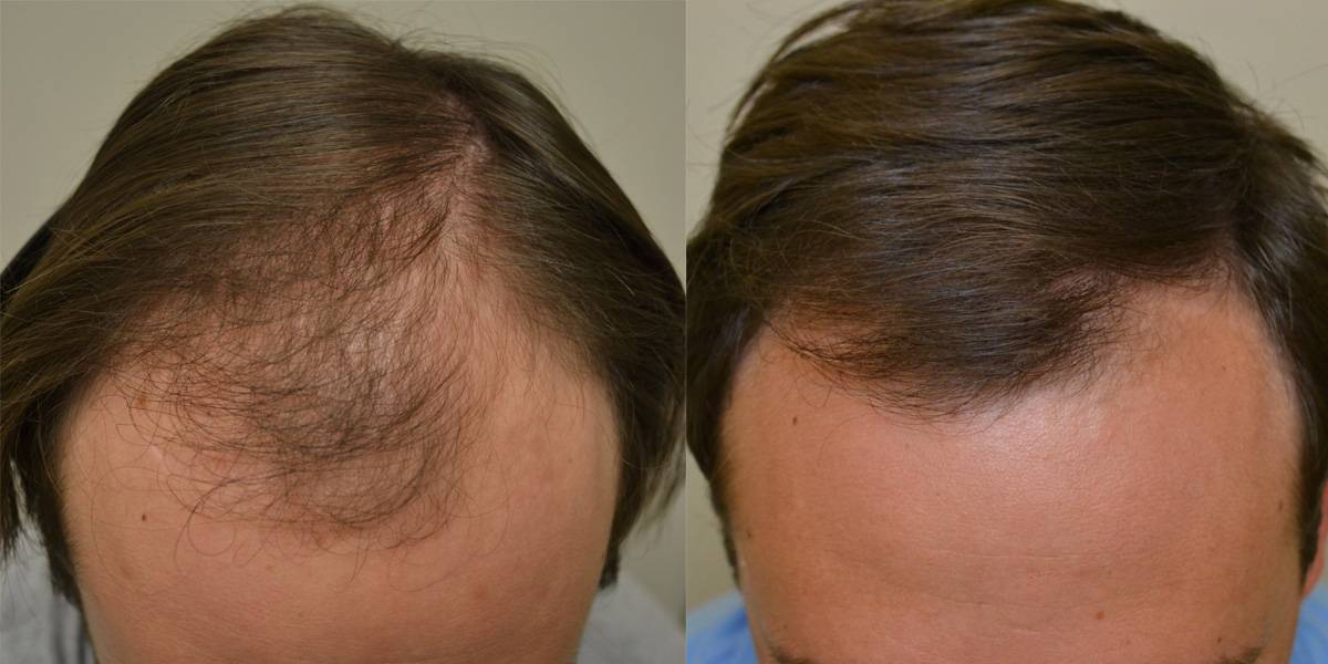 Волосы выпадают после лечения. Финастерид и миноксидил для волос. Миноксидил для волос для мужчин для головы. Миноксидил для головы до и после волос мужчин.