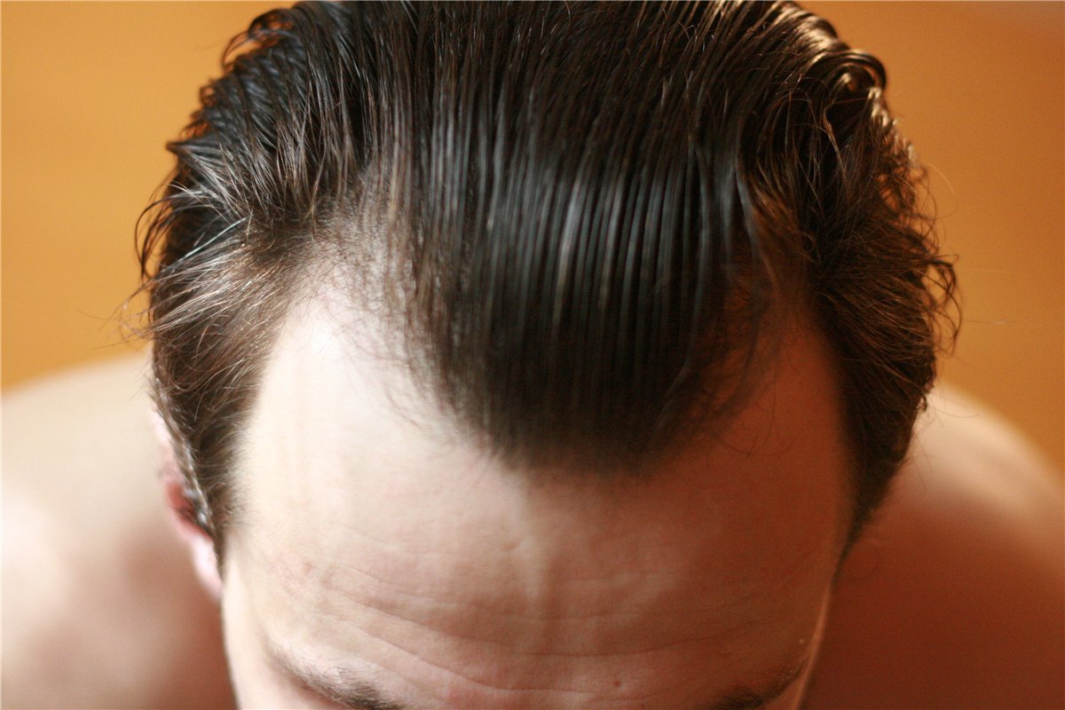 Как отрастить волосы на лбу мужчинам