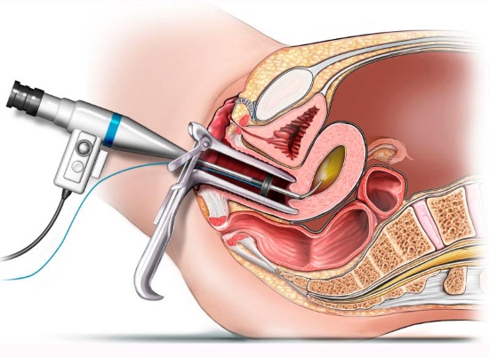 Процедура гистероскопии