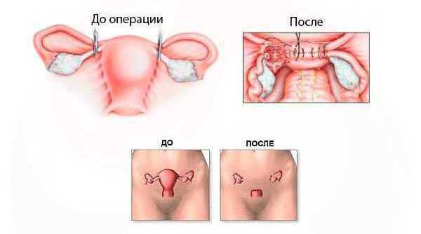 половая жизнь после удаления матки