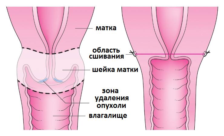 половая жизнь после операции по удалению матки