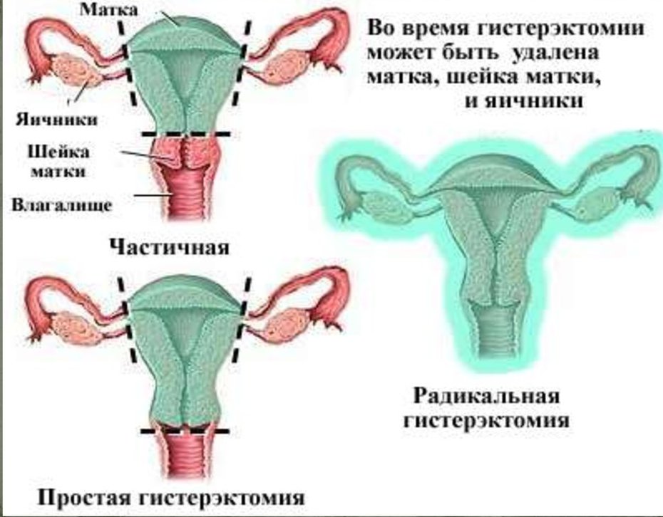 половая жизнь женщины после удаления матки