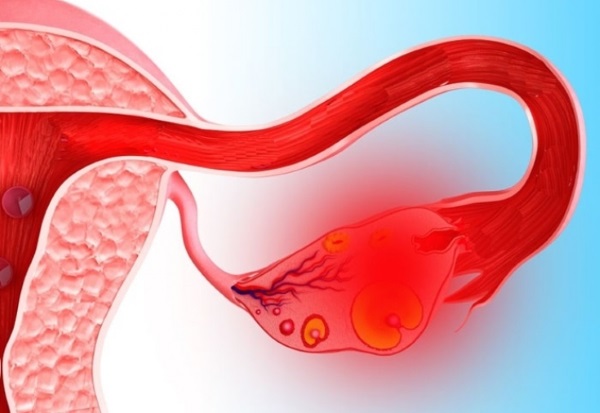 Как болят яичники у женщин. Симптомы заболеваний, воспаления. Что делать
