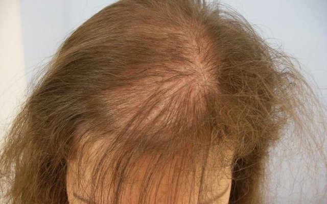 Почему волосы выпадают с луковицей и как это лечить? Советы трихологов