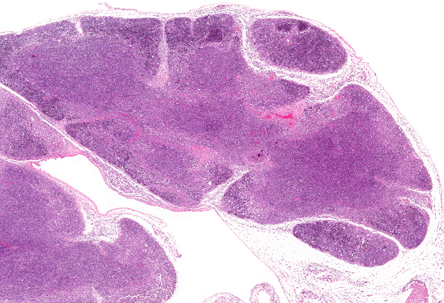 Некроз тимуса