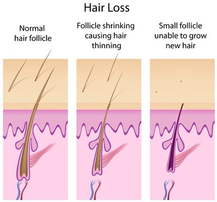 hair loss process