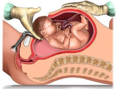 uterine scar pregnancy