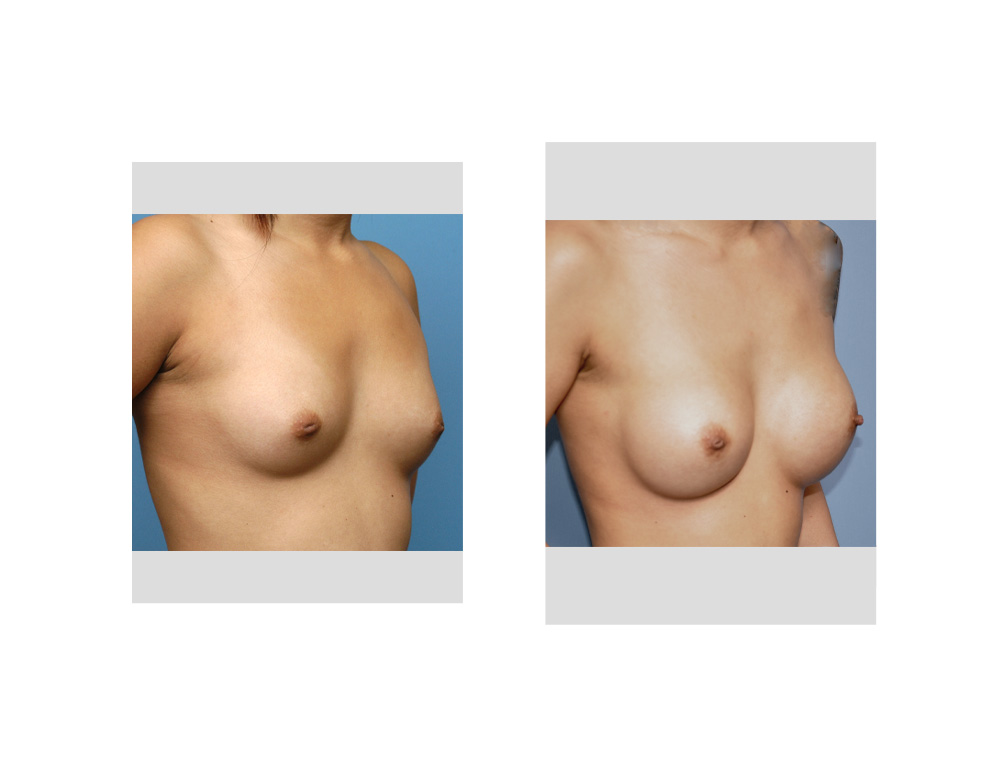 Asian Female Breast Augmentation result oblique view Dr Barry Eppley Indianapolis