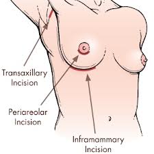 Breast Augmentation Incisions Dr Barry Eppley Indianapolis