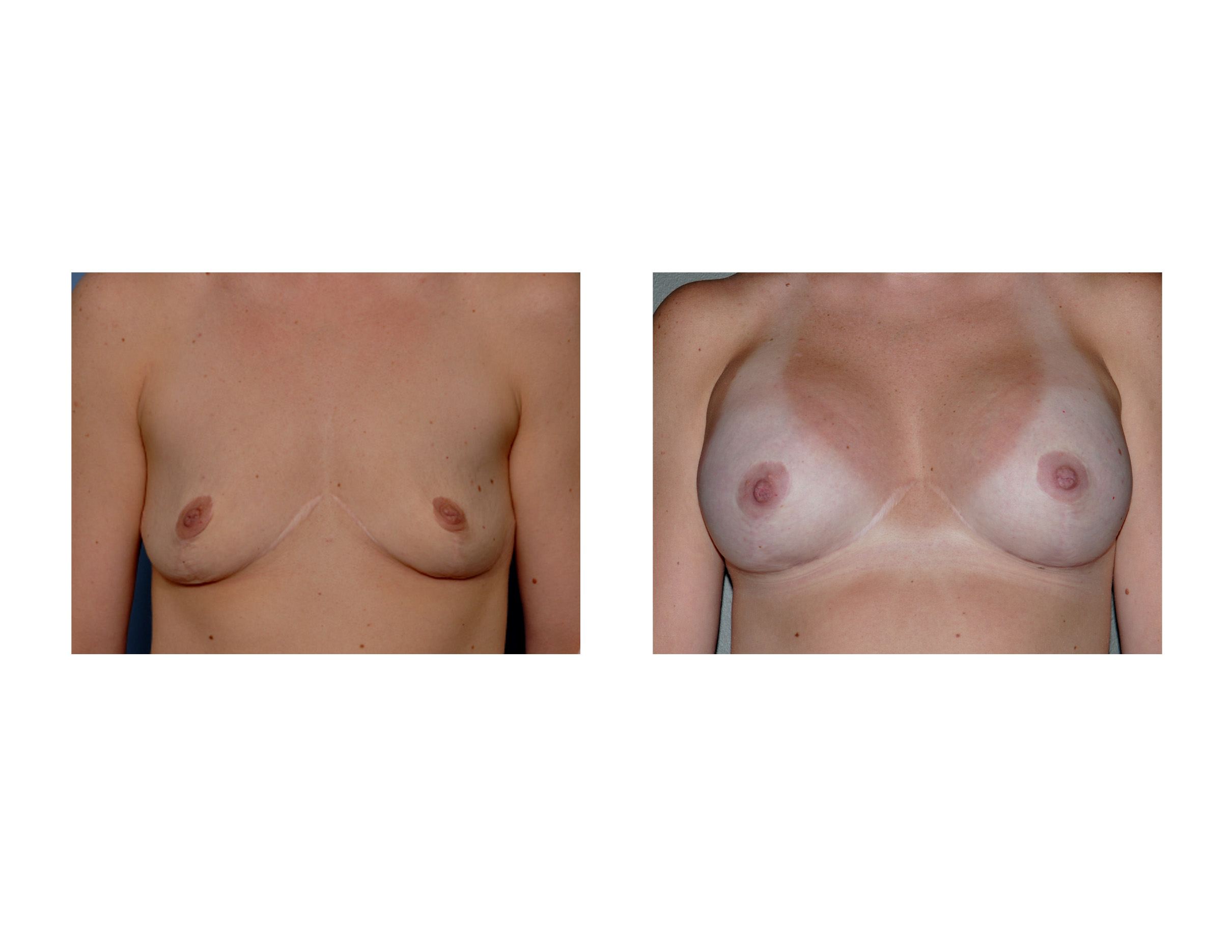 Breast Augmentation after Breast Reduction Dr Barry Eppley Indianapolis