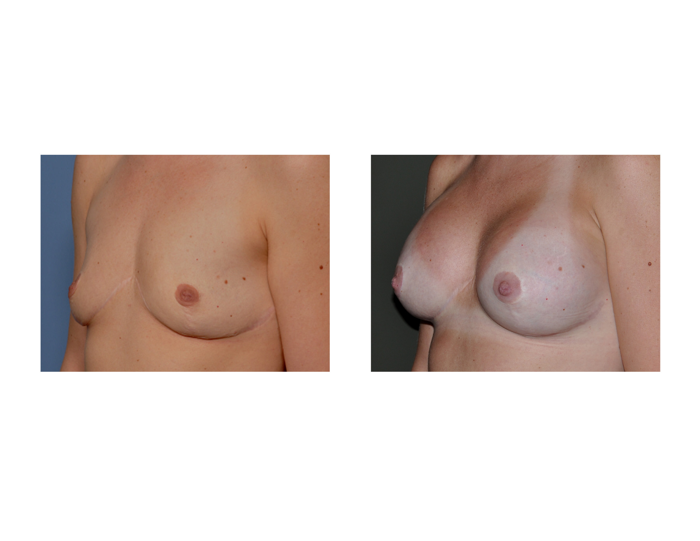 Breast Augmentation oblique view Dr Barry Eppley Indianapolis