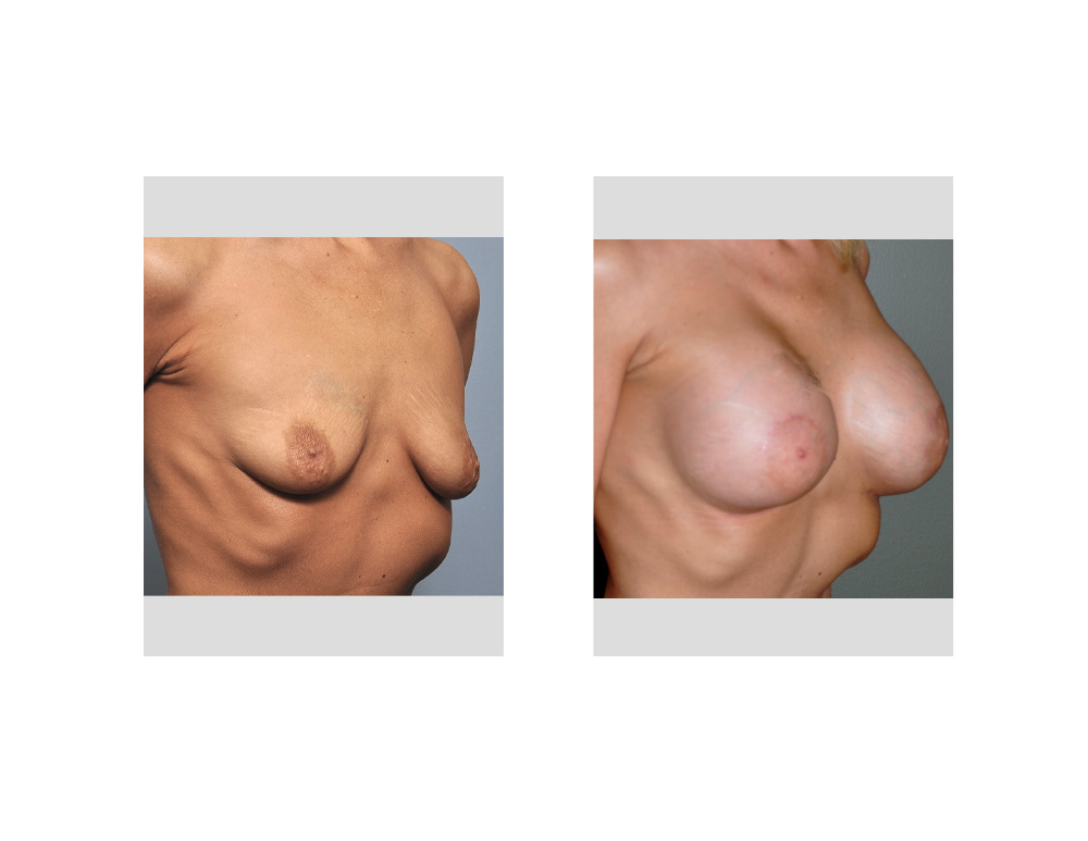 Nipple Lifts amd Breast Augmentation Dr Barry Eppley Indianapolis