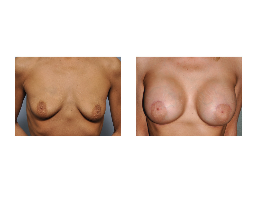 Nipple Lifts in Breast Augmentation Dr Barry Eppley Indianapolis