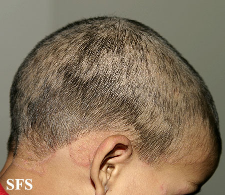 Scalp ringworm - Tinea capitis