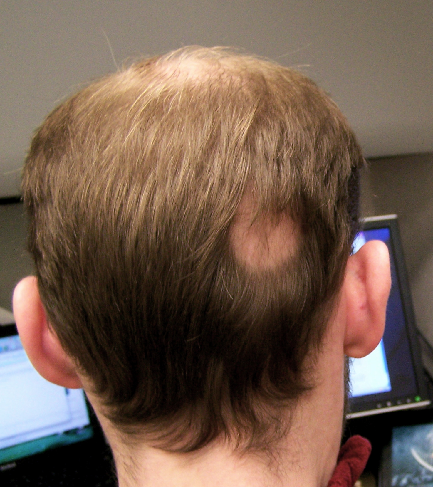 Причины выпадения волос у подростка. Гнёздная (очаговая алопеция). Очаговая алопеция (alopecia Areata). Гнёздная алопеция у детей.