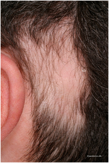 Заболевания волос - очаговая алопеция
