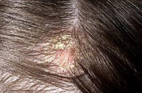 Как лечить дерматит на голове в волосах. Лечение себорейного дерматит кожи головы народными средствами и медицинскими препаратами
